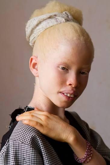 Albinism